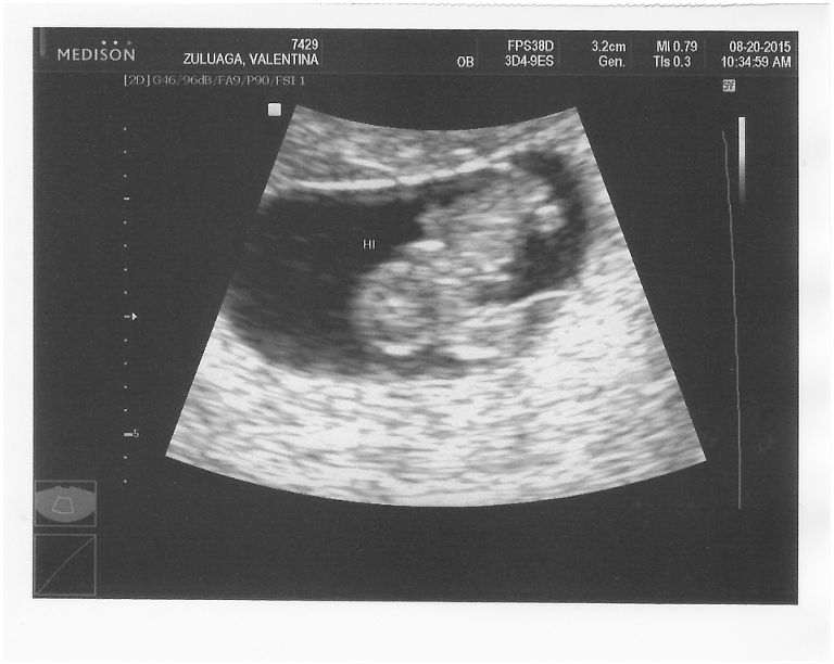 Expecting a baby - ultrasound week 8