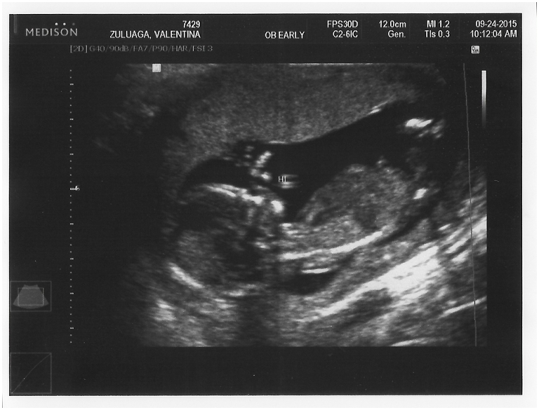 Expecting a baby - ultrasound week 13