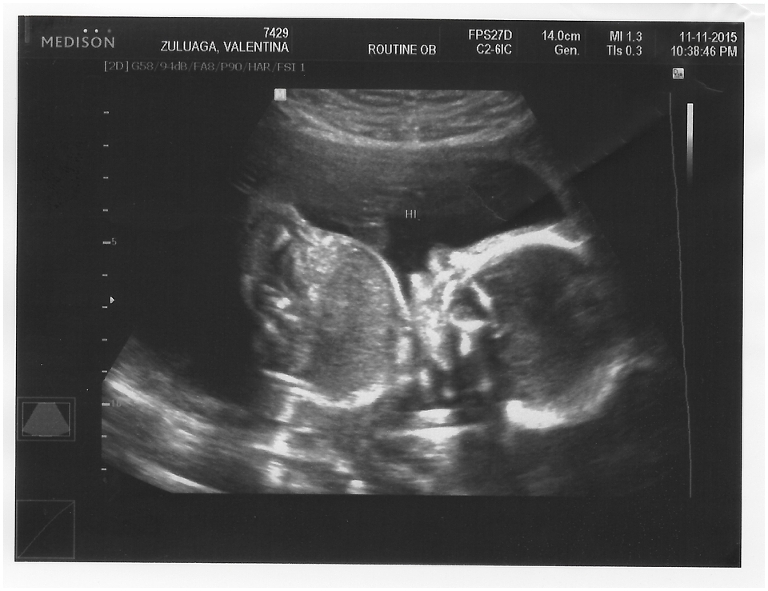 Expecting a baby - ultrasound week 20